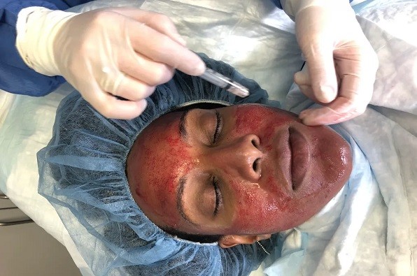 Glass Skin PRP Treatment